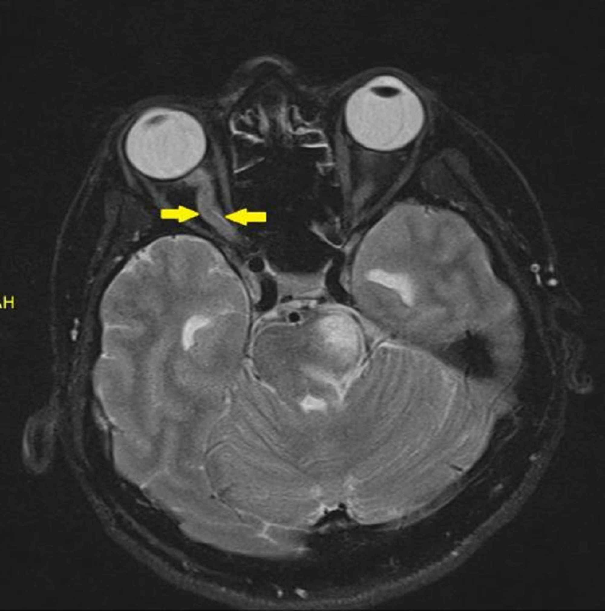 Optic Neuritis Mri