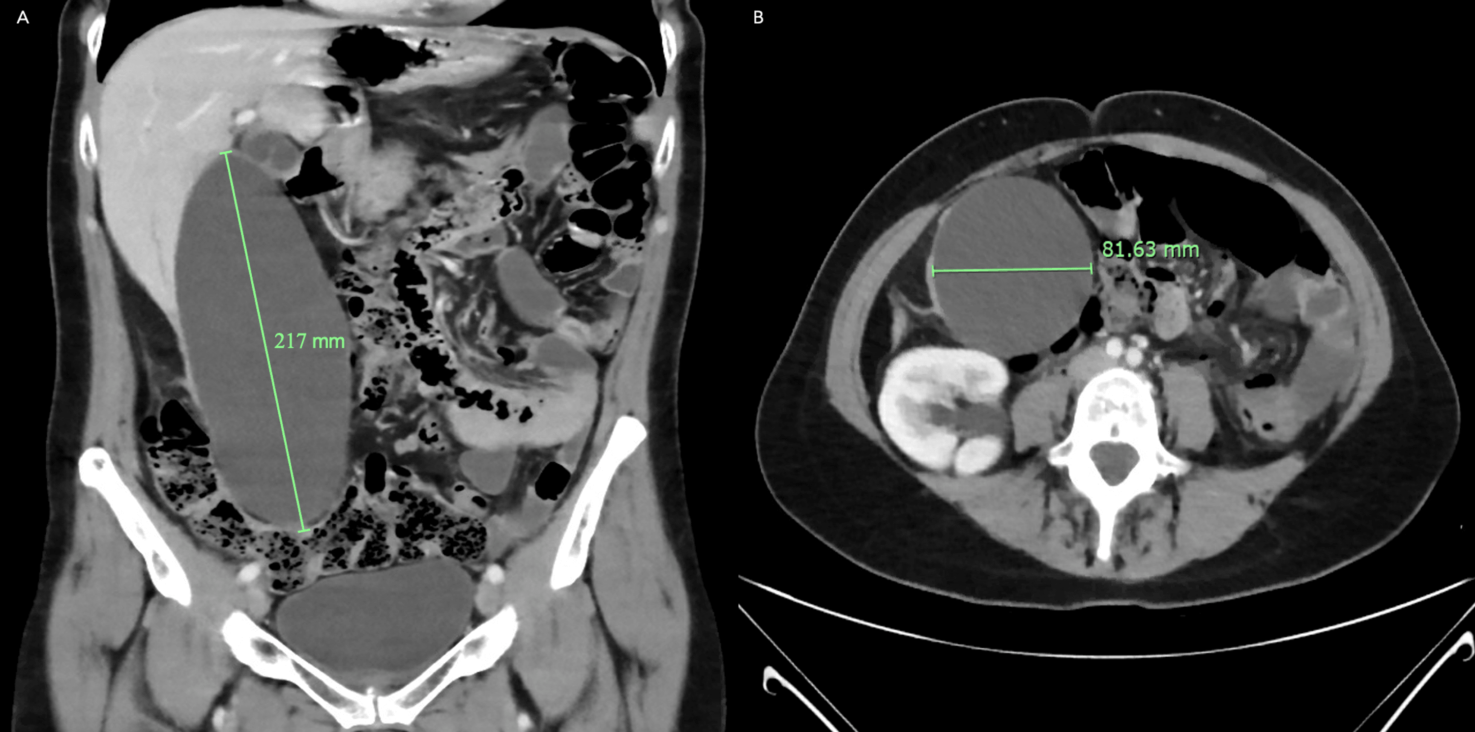 Cureus | A Rare Case of Calculous Gallbladder Hydrops Presenting With ...