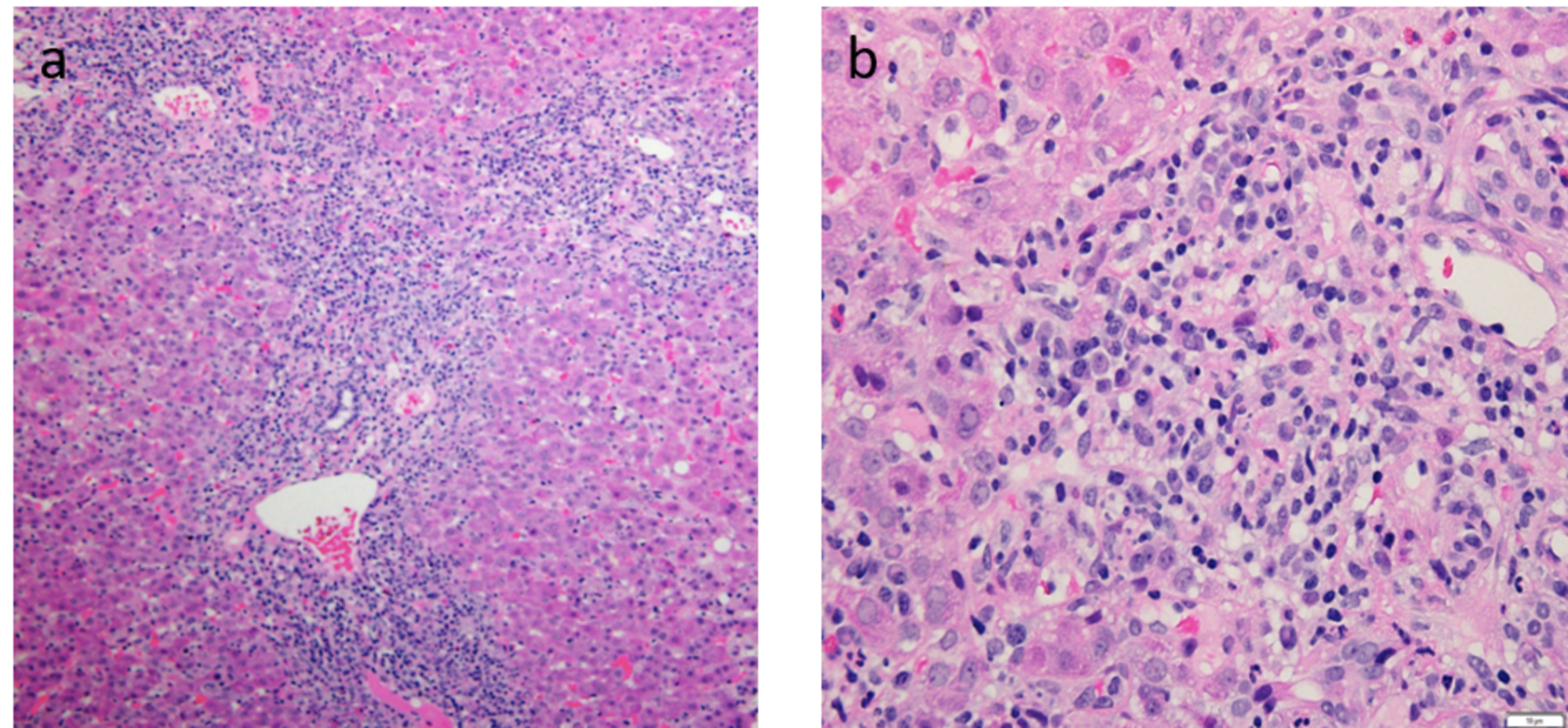 Cureus Autoimmune Hepatitis Refractory to Treatment Due to Underlying Grave’s Disease