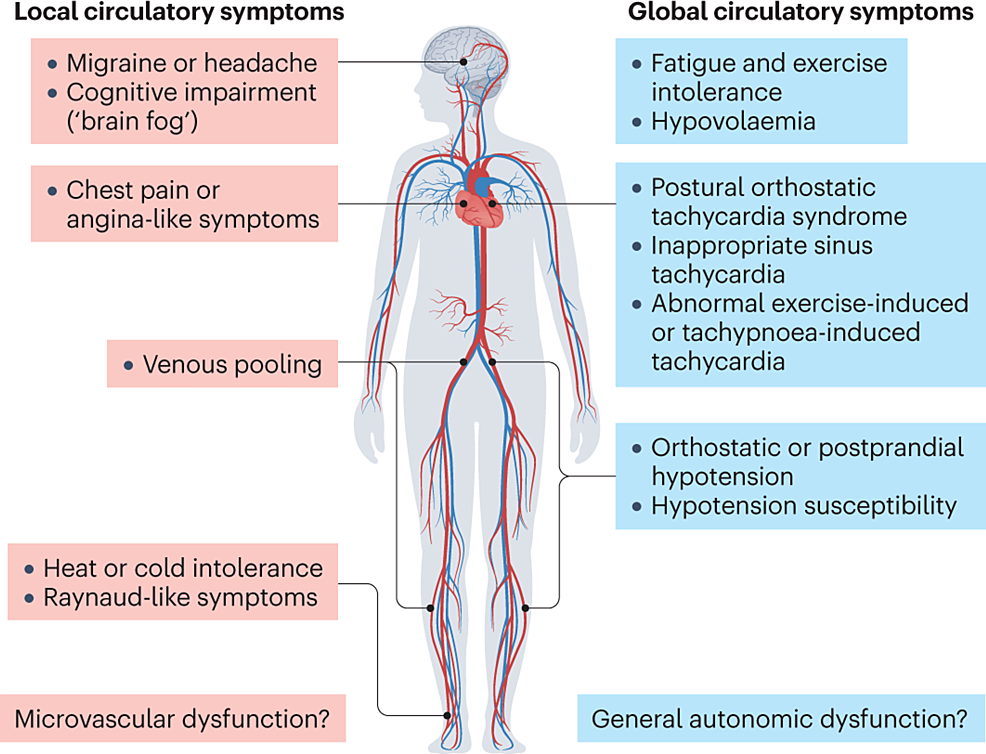 Cureus COVID19Induced Postural Orthostatic Tachycardia Syndrome and