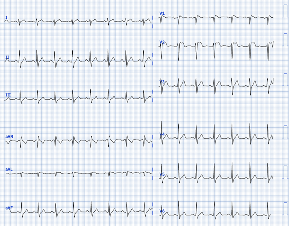 Cureus | Unmasking Idiopathic Brugada ECG Pattern: Inducible Type 1 ...