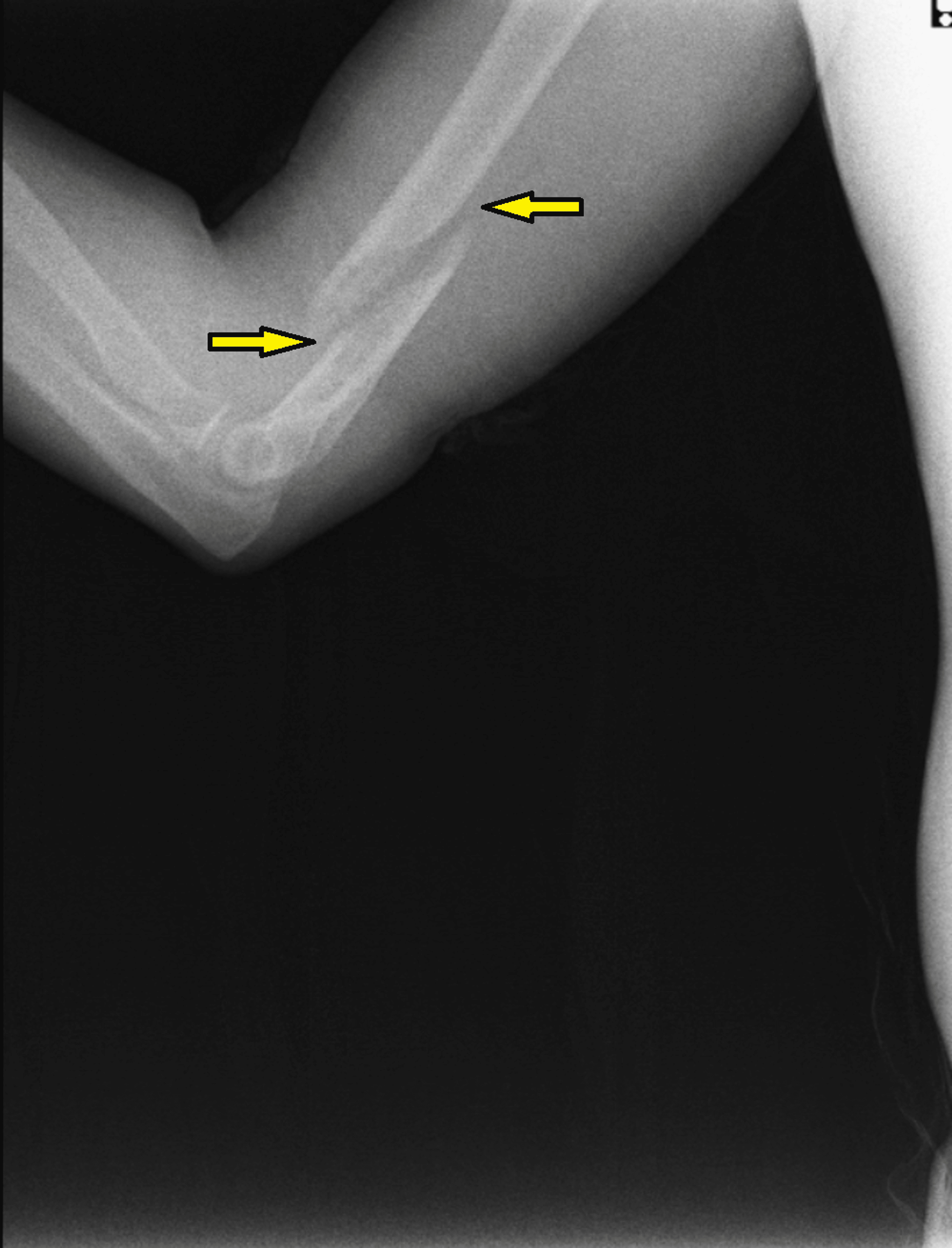 Cureus Conservative Management of a Distal Humerus Spiral Fracture