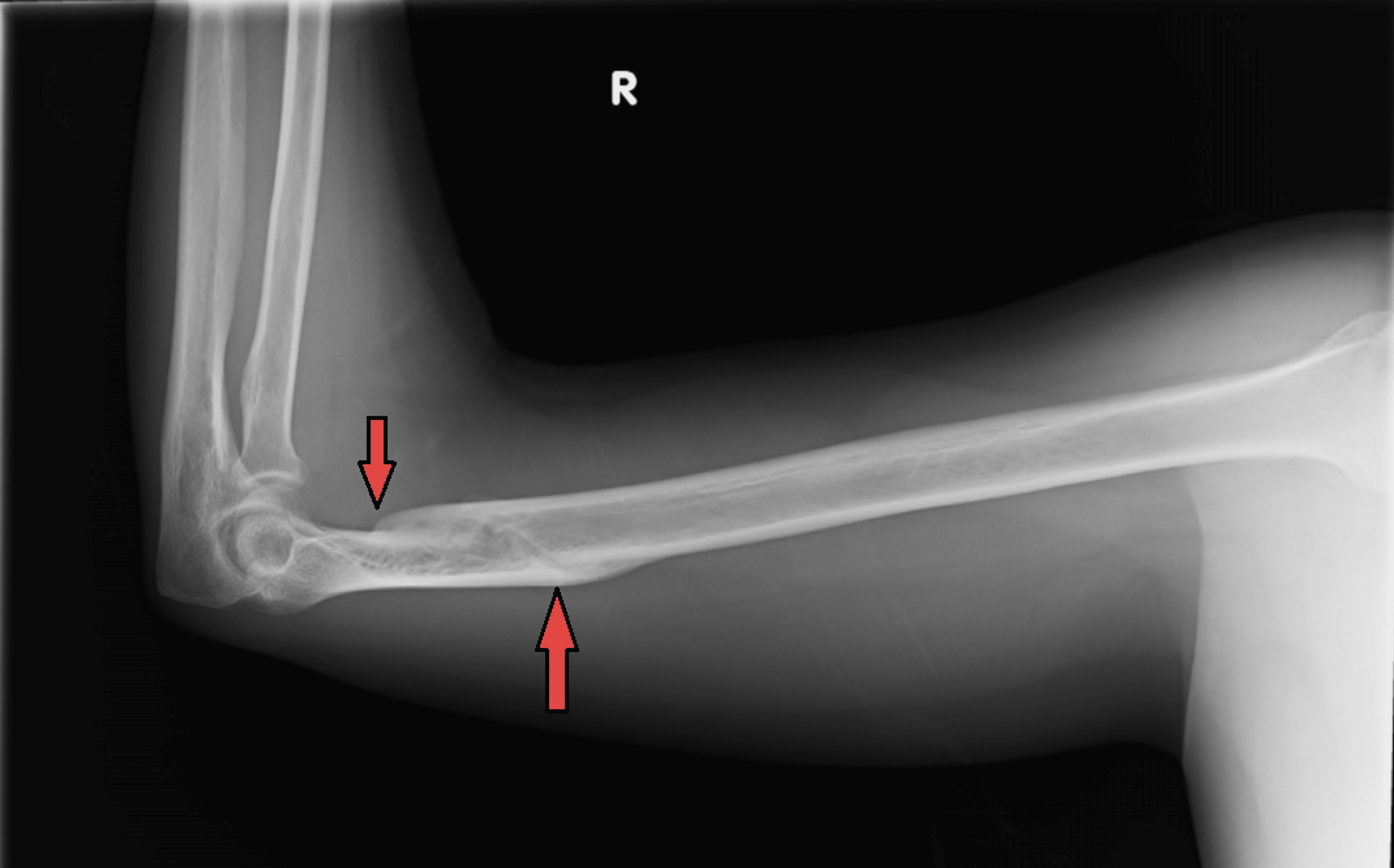 Cureus Conservative Management of a Distal Humerus Spiral Fracture