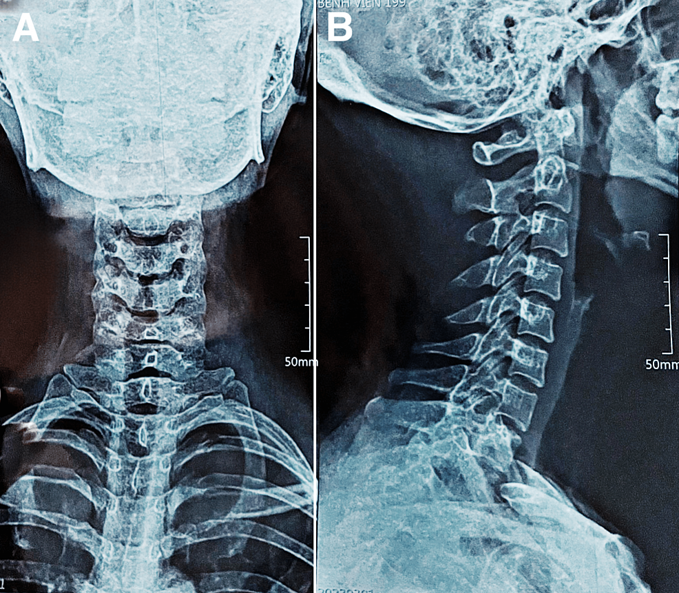 Cureus | Secondary Holocord Syringomyelia Associated With Spinal ...