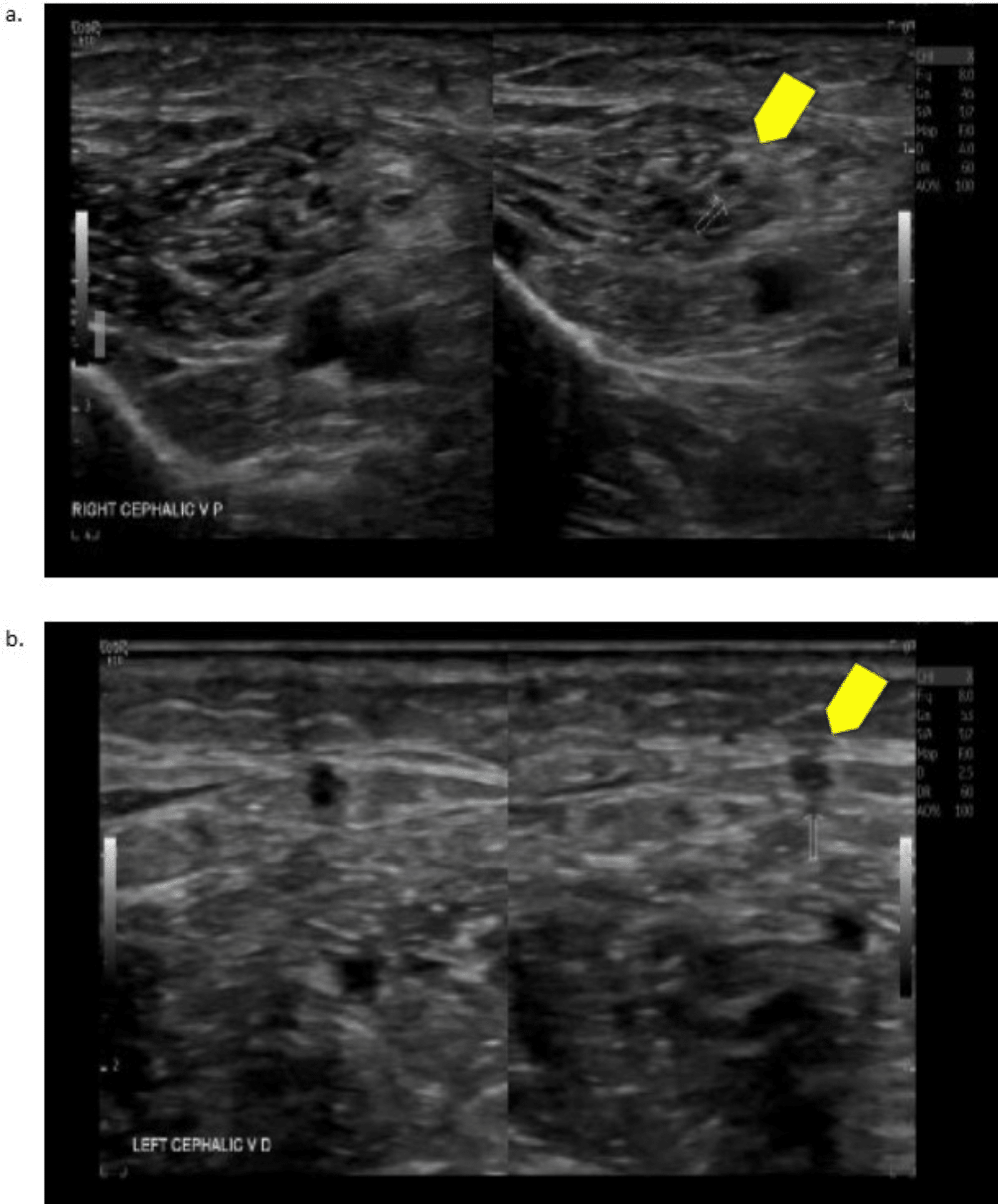 An Unusual Case of Bleeding Acquired Hemophilia A Cureus