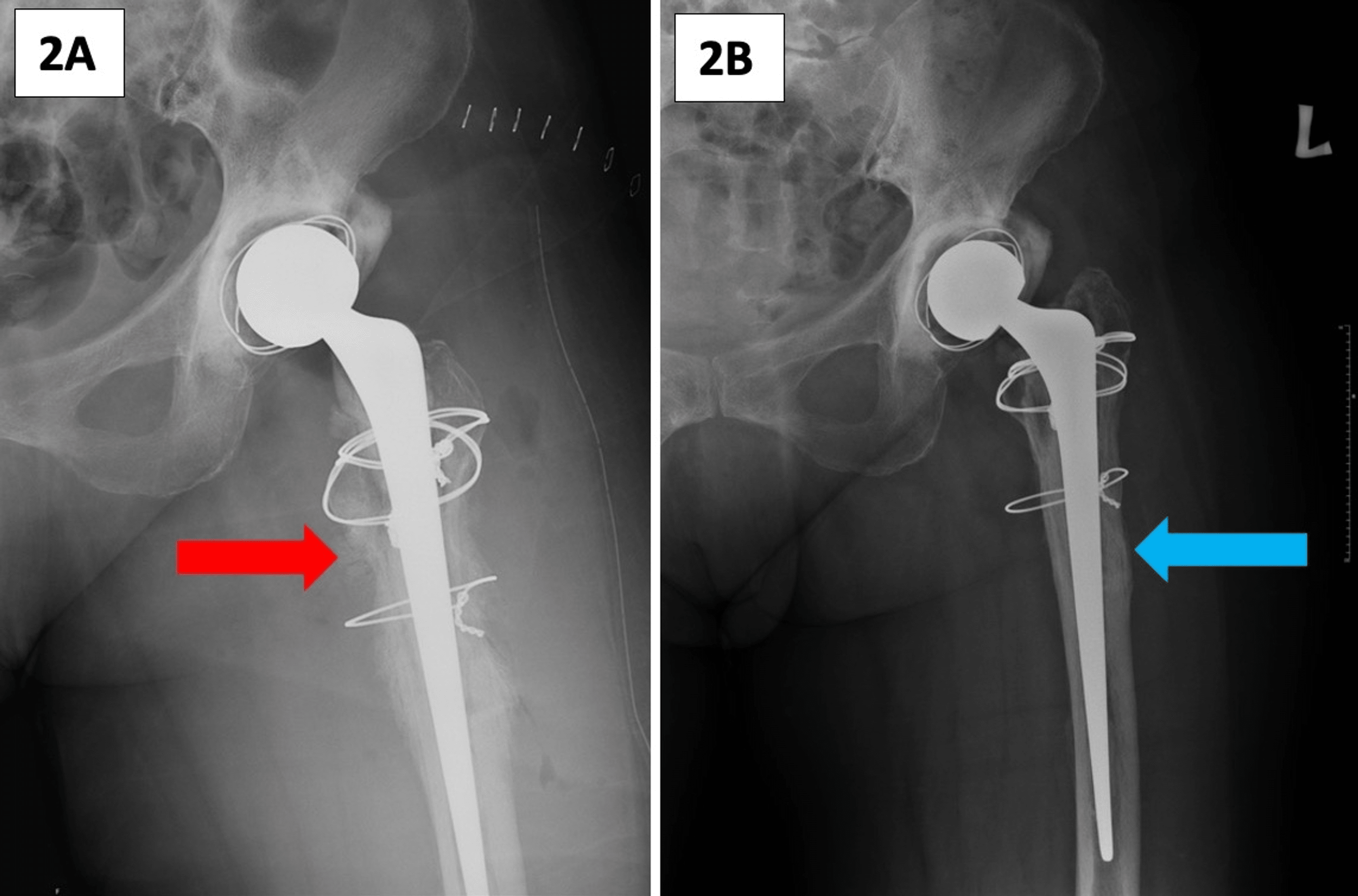 CustomMade Articulating Spacer (CUMARS) The Resolution of Periosteal