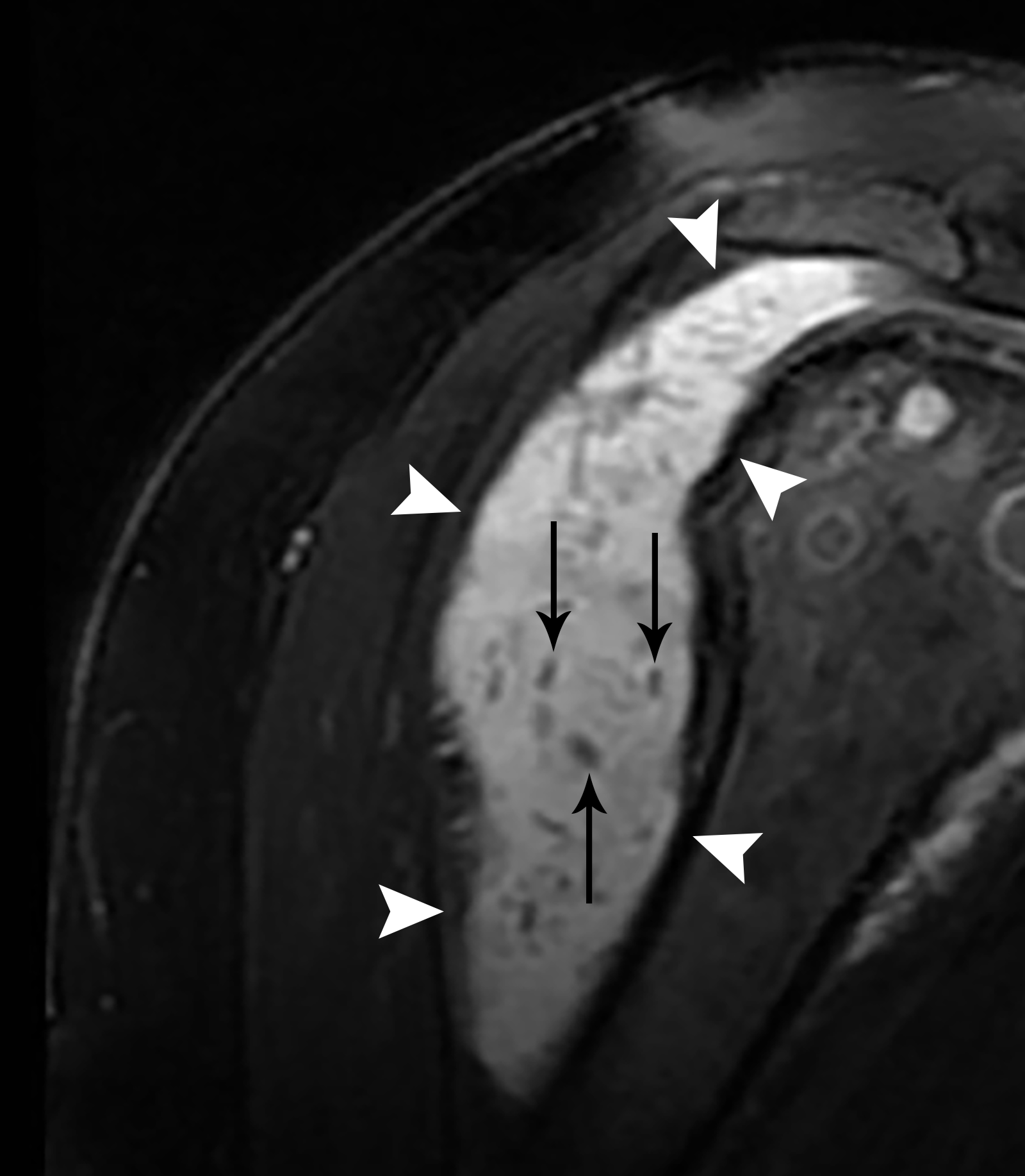 Cureus | Rice Body Formation Within a Peri-Articular Shoulder Mass