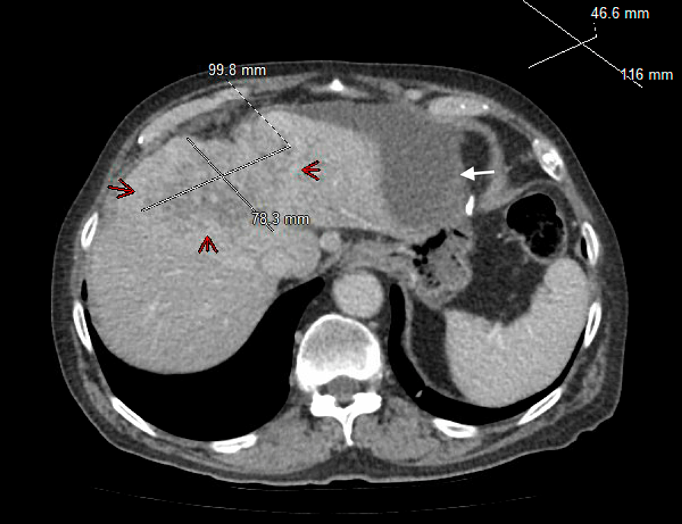 Spontaneous Biloma With a Hepatic Mass Cureus