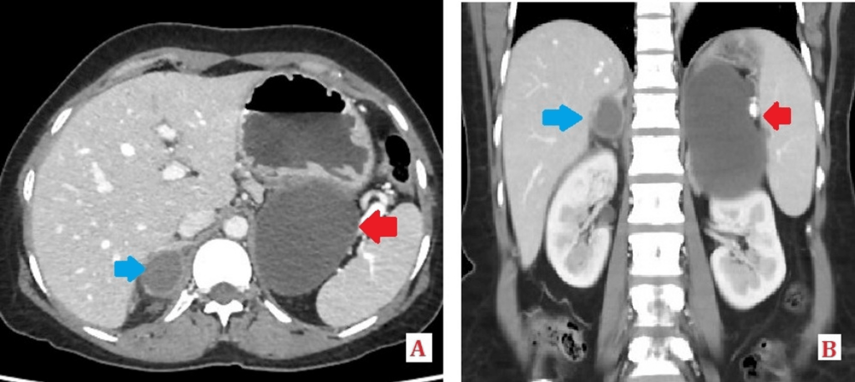 Cureus | Gastric Duplication Cyst: A Report of a Rare Case