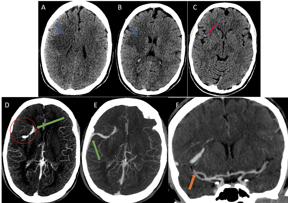 Cureus | Developmental Venous Anomaly Presenting as an Acute Stroke Mimic