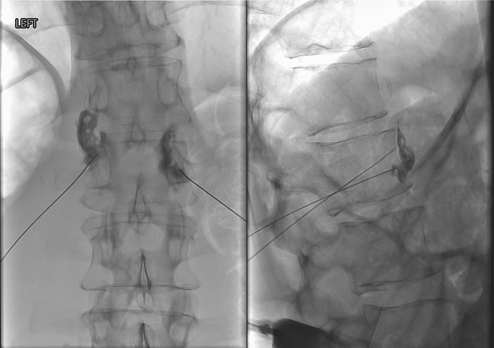 Cureus Possible Transient Anterior Spinal Artery Syndrome After