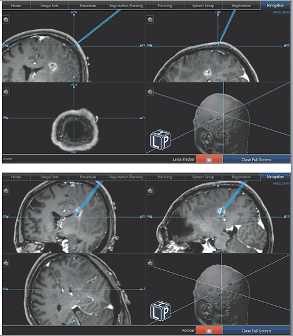 Frameless Stereotactic Insertion of Viewsite Brain Access System with
