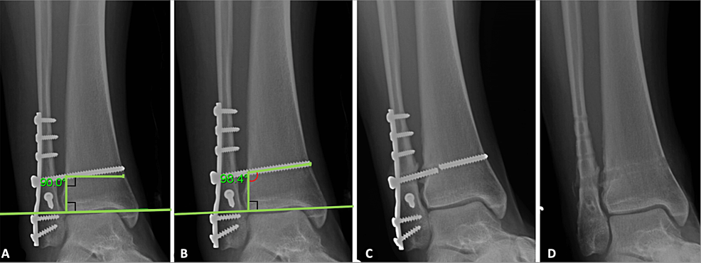 lange-protection-tibia-adulte