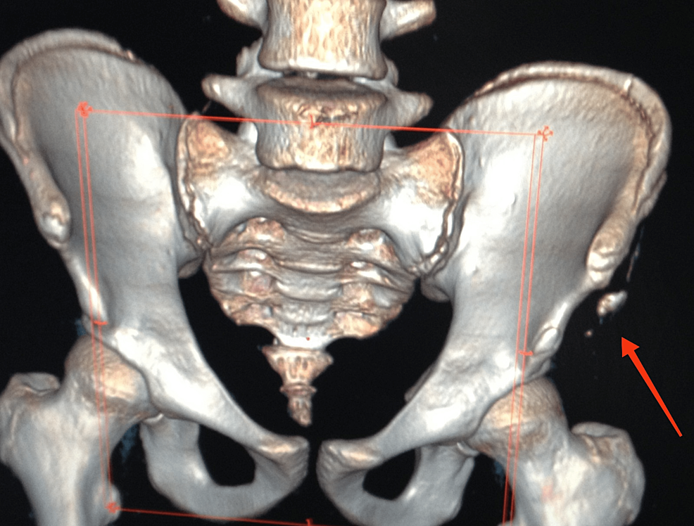 Cureus, Avulsion Fracture of the Anterosuperior Iliac Spine: A Case Report