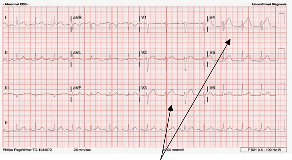 Spontaneous Coronary Artery Dissection (SCAD) in an Atypical Patient ...