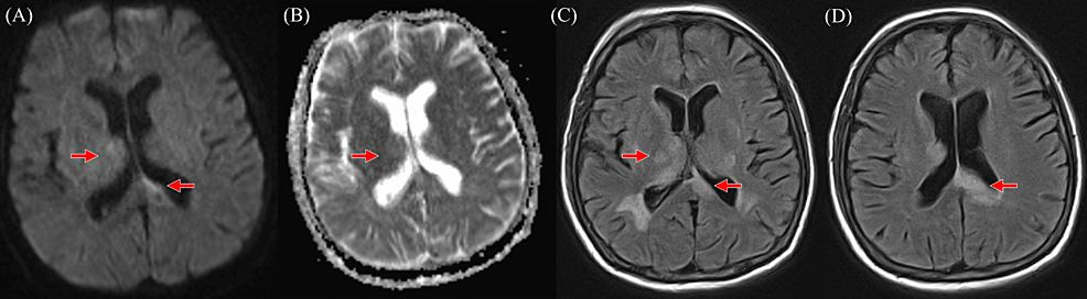 cureus-fever-cognitive-decline-and-multifocal-t2-hyperintensities