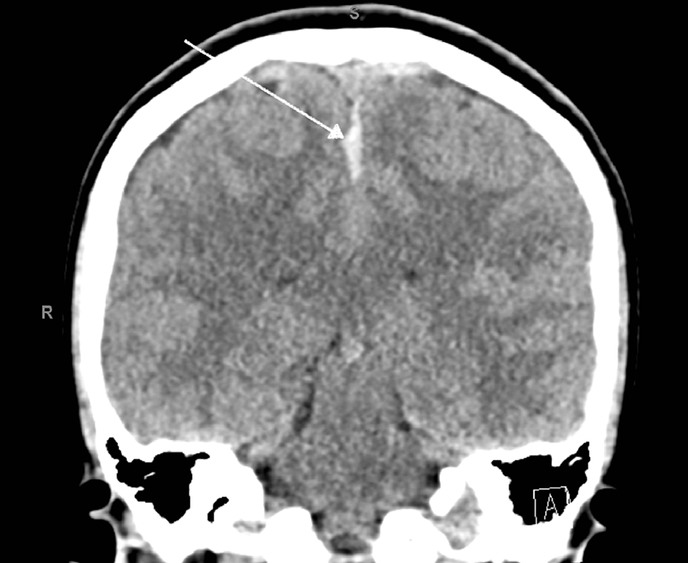 Post Dural Puncture Subdural Hematoma A Rare Iatrogenic Complication