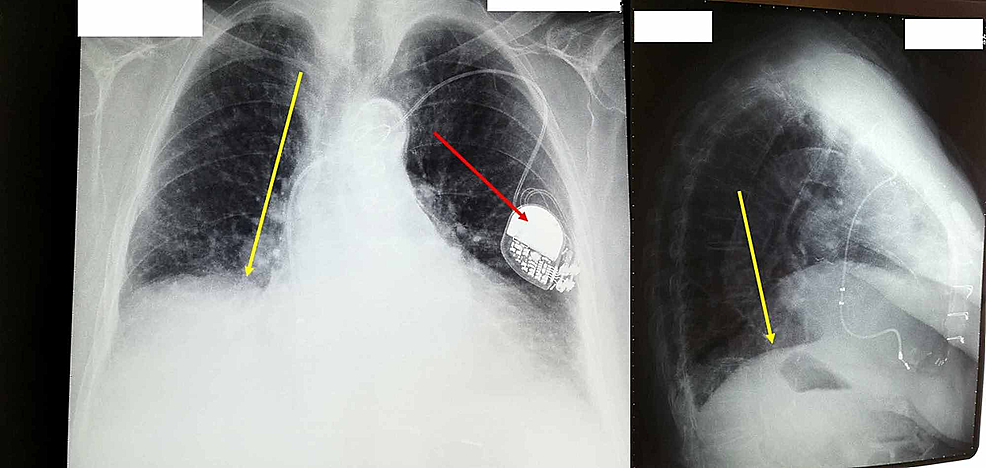 X-ray:-instrumental-examination-showing-an-elevation-of-the-diaphragm-on-the-right-side