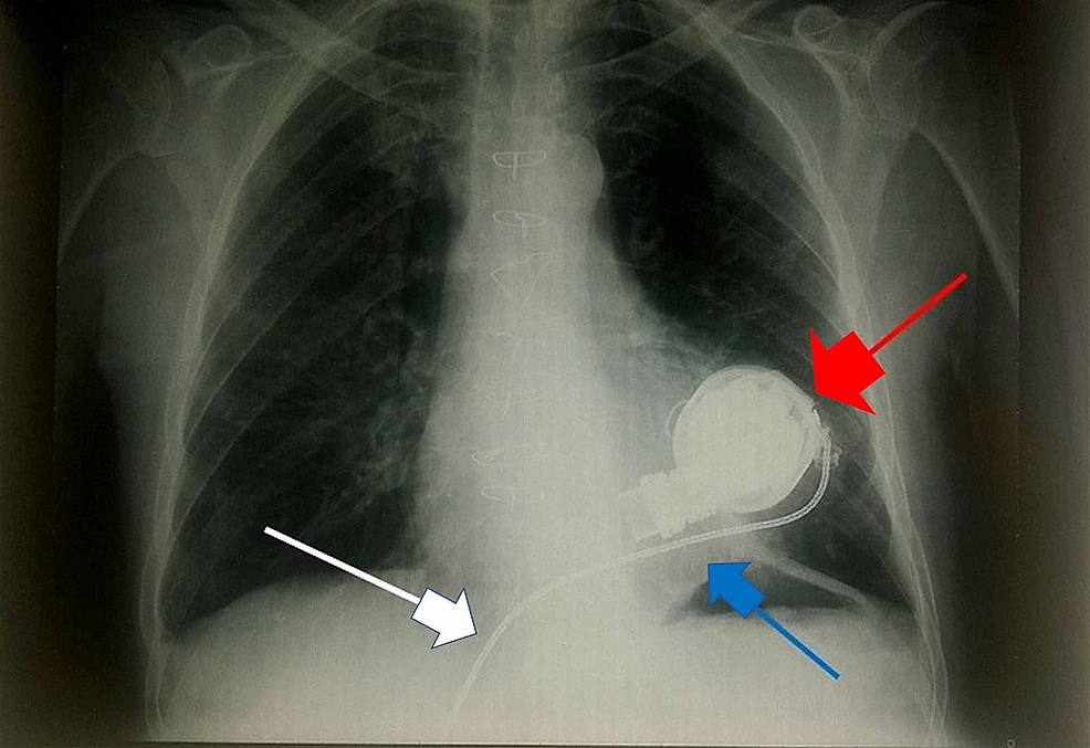 X-ray-showing-the-position-of-the-L-VAD-