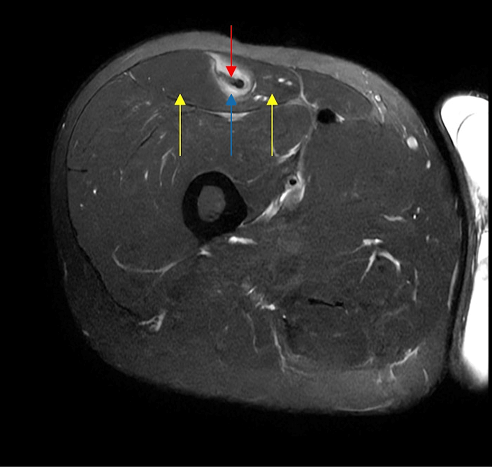 Cureus Intramuscular Degloving Injury of the Rectus Femoris From
