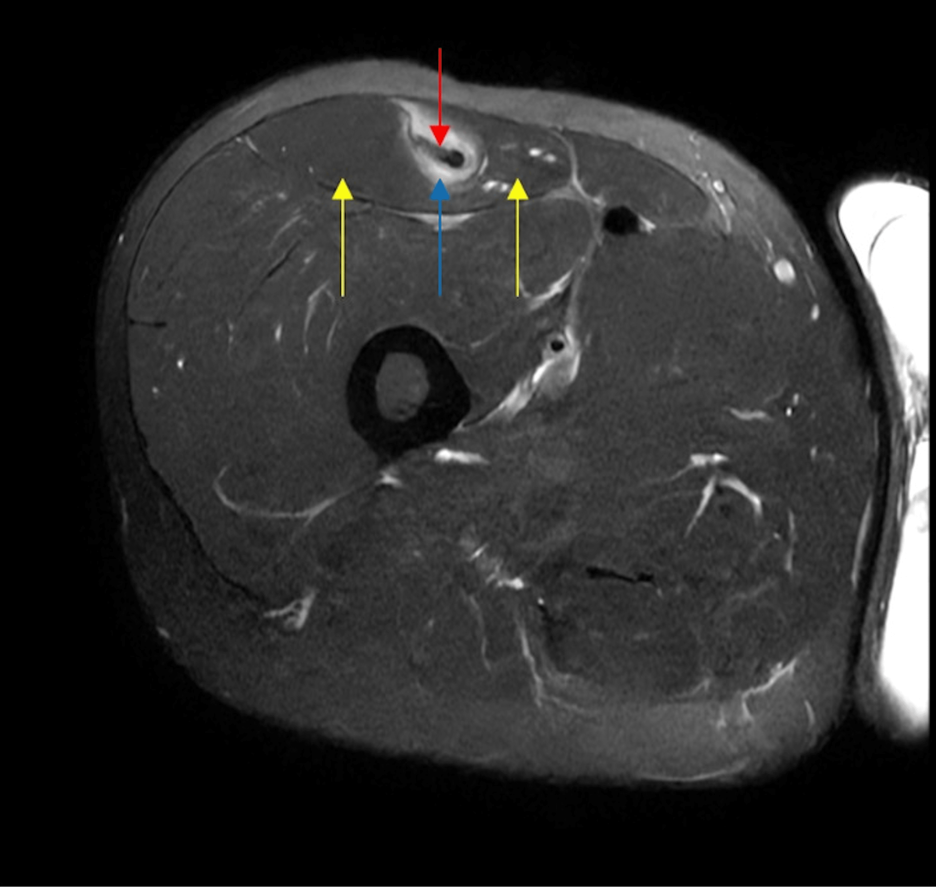 Intramuscular Degloving Injury of the Rectus Femoris From Kickball A