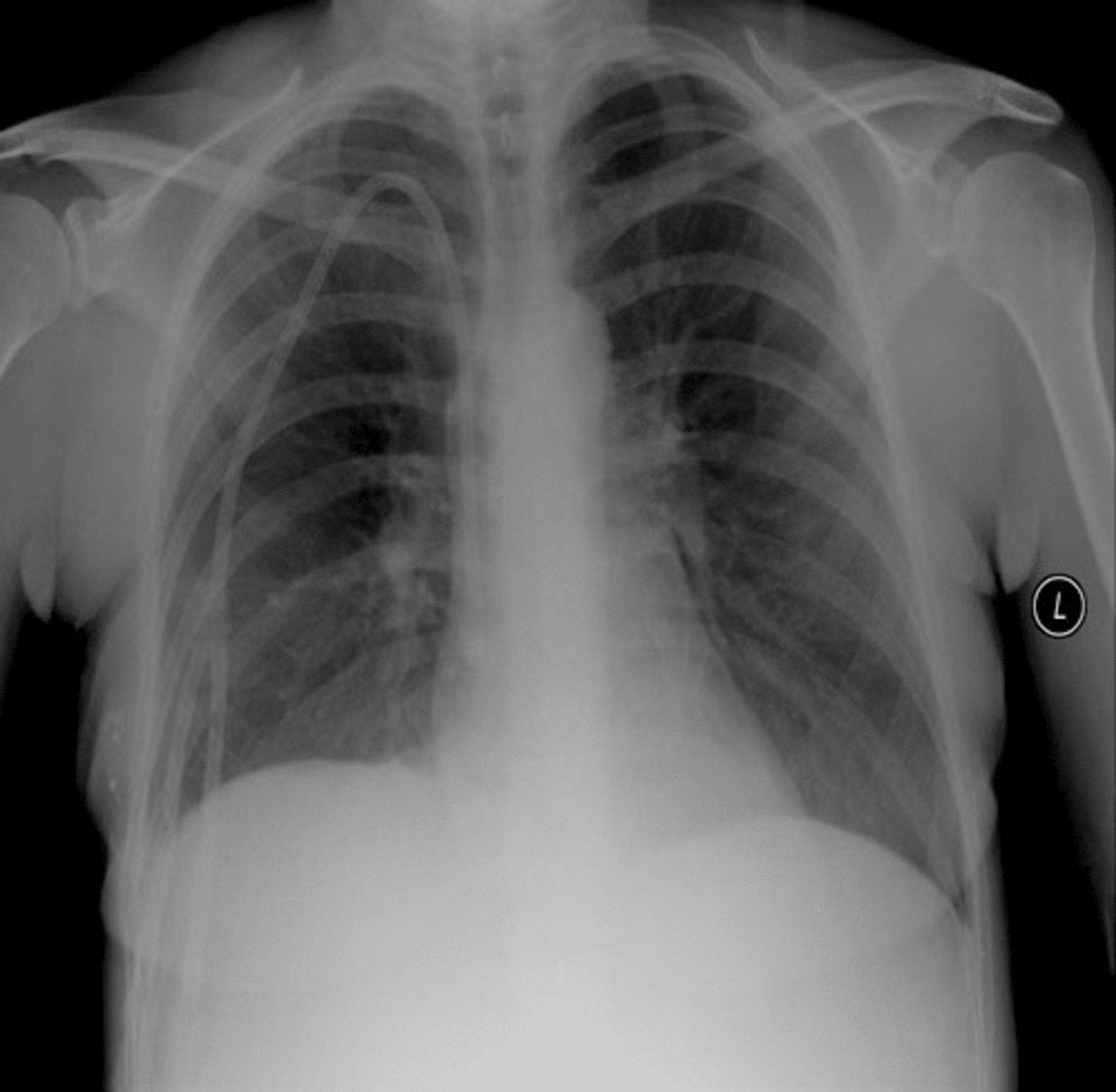 Cureus Deep Learning Classification of Tuberculosis Chest Xrays