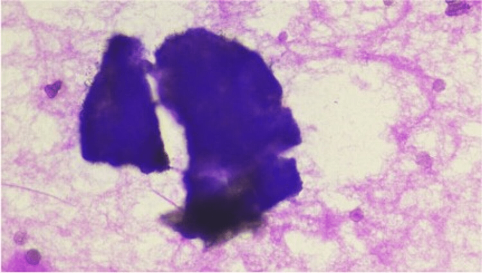Cureus, Recurrent Primary Peritoneal Psammocarcinoma: A Case Report on a  Diagnostic Challenge in Cytology