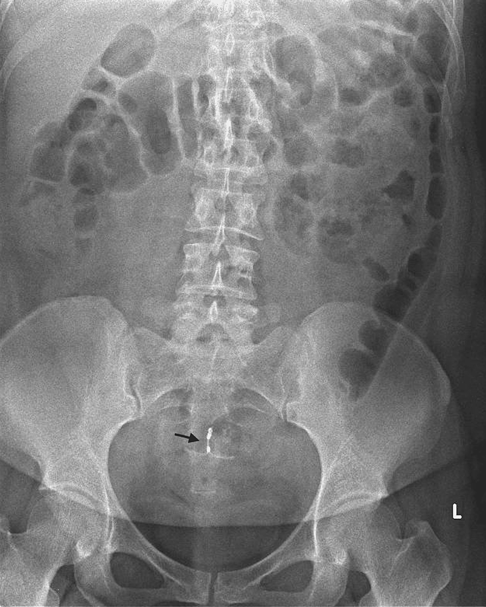 An Unusual, Delayed Presentation of a Migrated Intrauterine ...