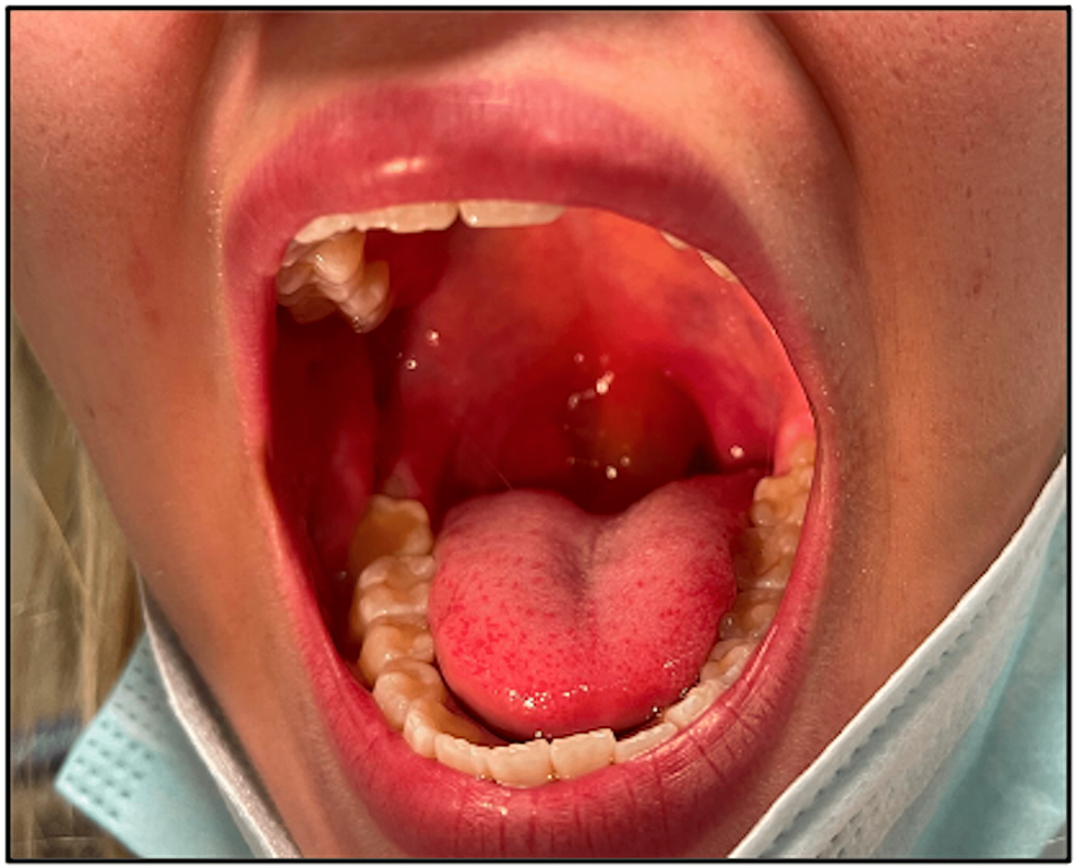 angioedema tongue