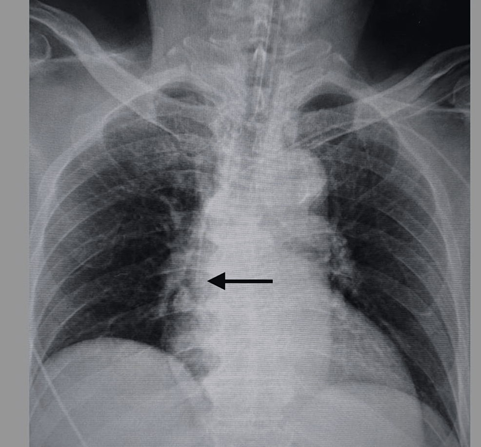 The Tip Position of Peripherally Inserted Central Catheters by the ...