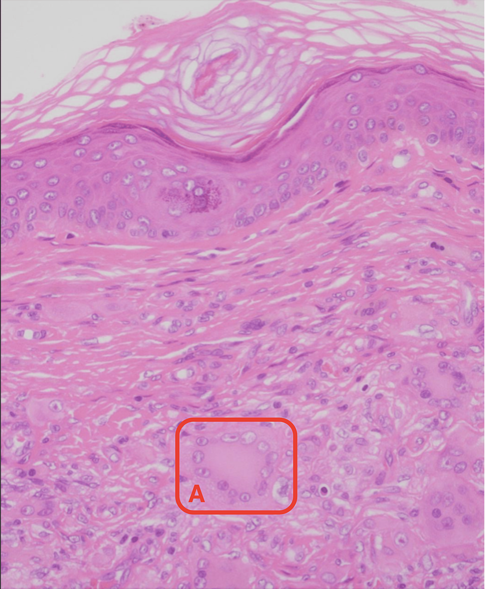 Cureus | Rare Cutaneous Manifestations of Erdheim Chester Disease: A ...