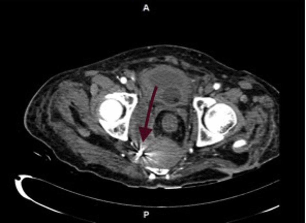 Cureus | An Unusual Presentation of Pseudomembranous Colitis