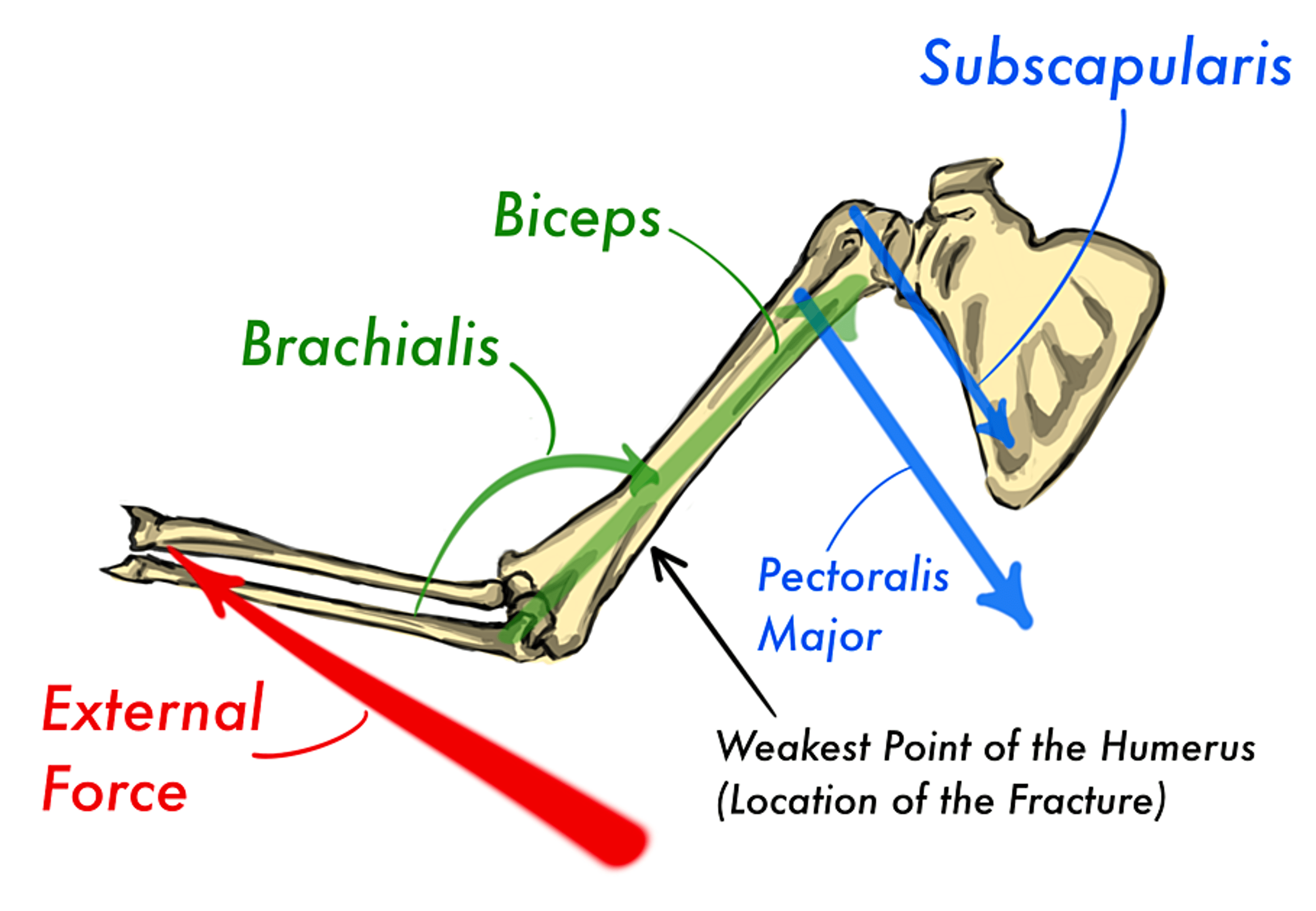 Cureus Conservative Management of a Distal Humerus Spiral Fracture