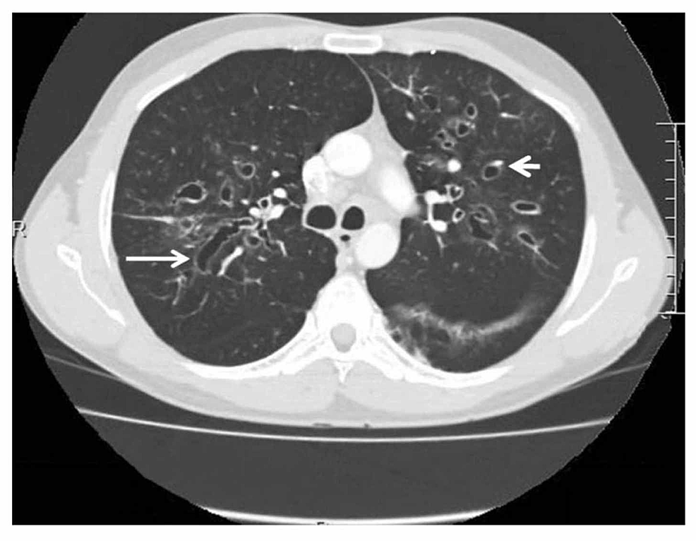 Computed-Tomography-Scan-of-Thorax-Showing-Central-Bronchiectasis-in-Case-of-ABPA