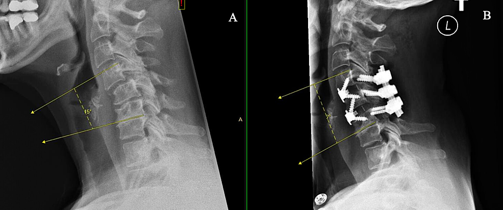 Lateral-cervical-spine-X-rays-showing-preoperative-sagittal-Cobb-angle-of-+15-(A)-and-postoperative-Cobb-angle-of-+7-(B).