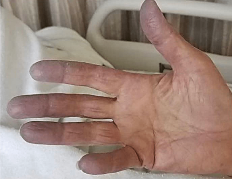 Cureus Antisynthetase Syndrome With Paraneoplastic Antibodies