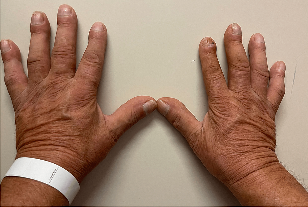 pierre-marie-bamberger-syndrome-leading-to-the-diagnosis-and-surgical