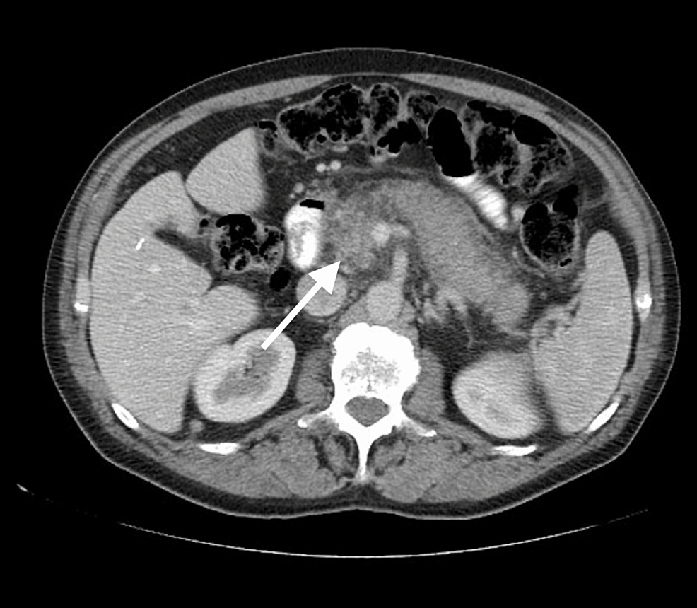 Investigating the Link Between Abdominal Pain, Weight Loss