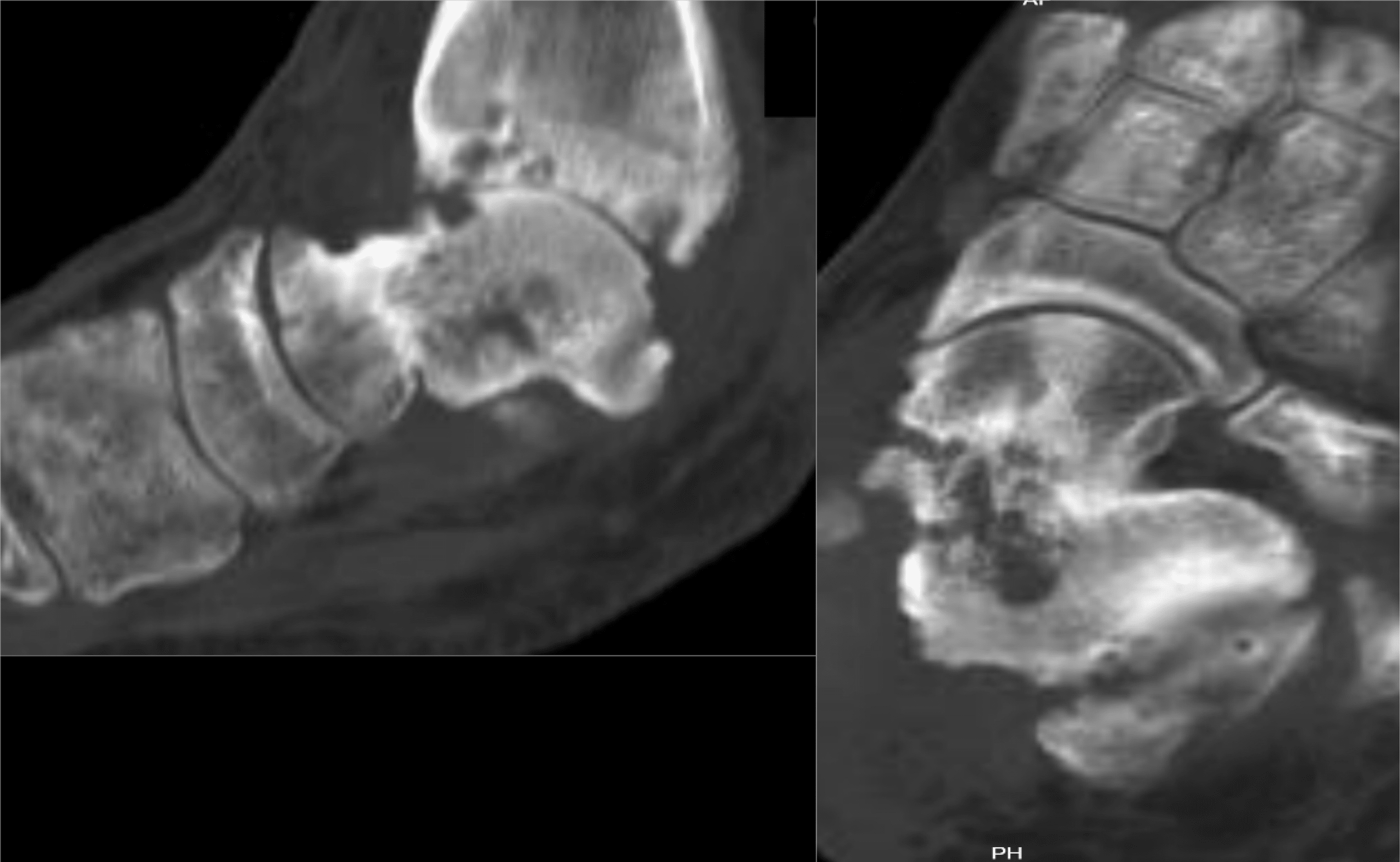 Open Fracture Dislocation Of The Talus With Partial Talar Extrusion: A ...