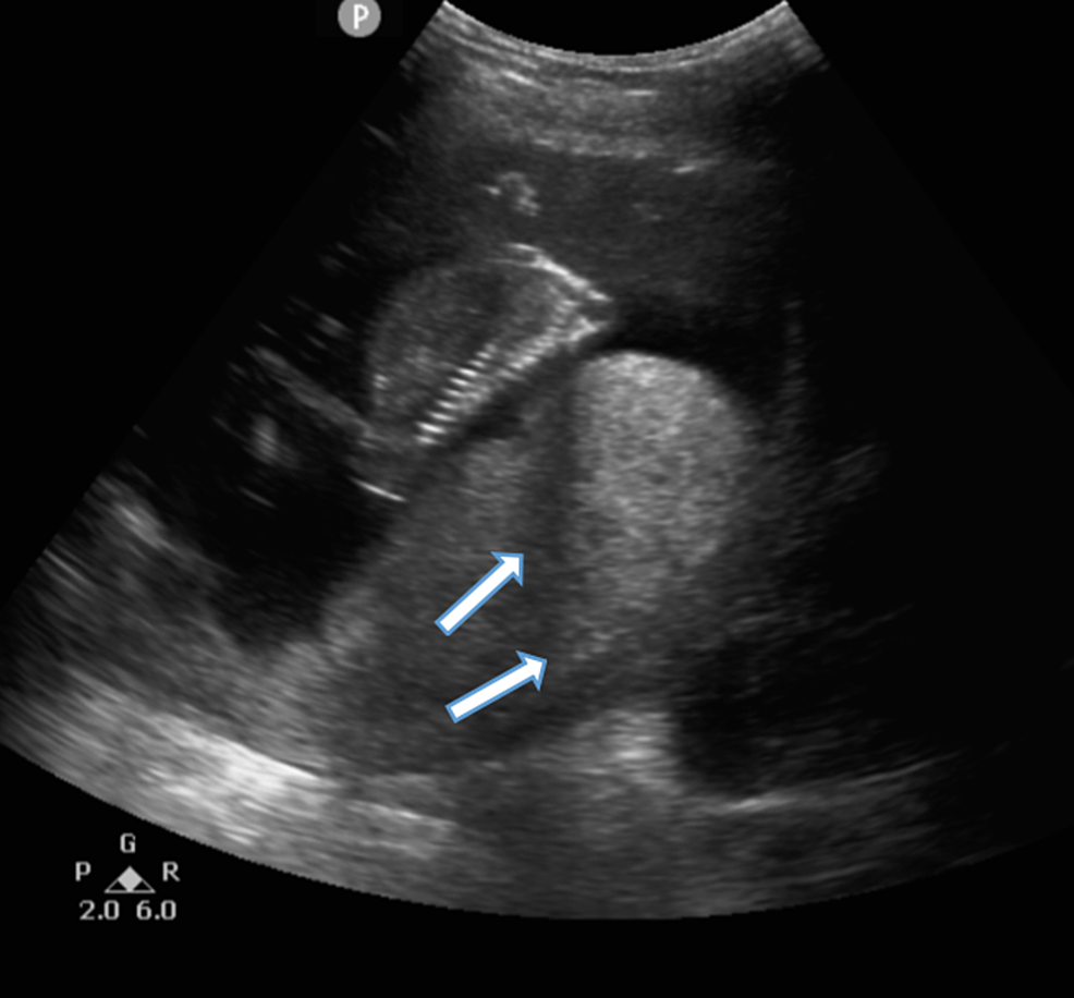 A Comparison of the Clinical Presentation of Ovarian Hyperstimulation ...