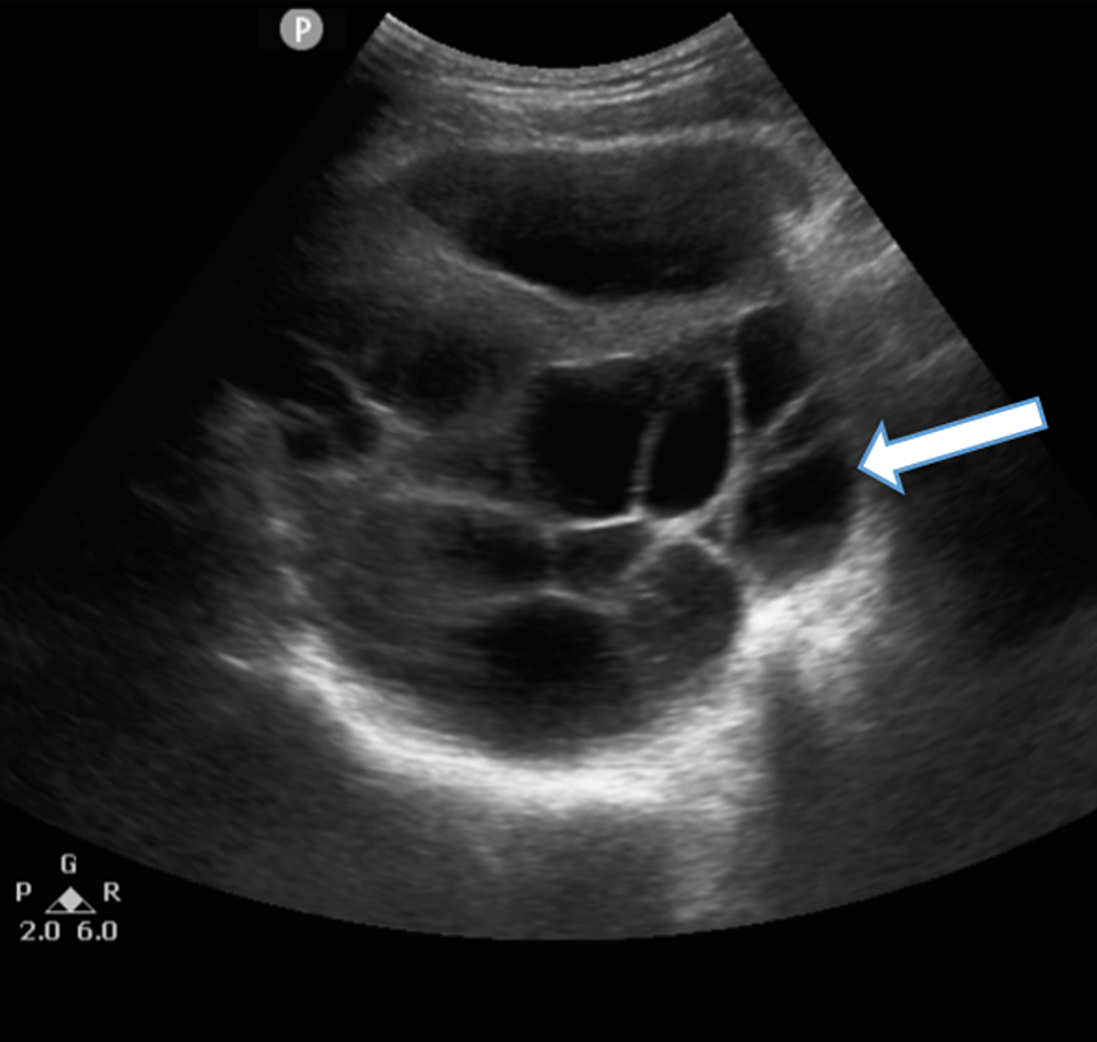 Normal transabdominal pelvic ultrasound | Image 