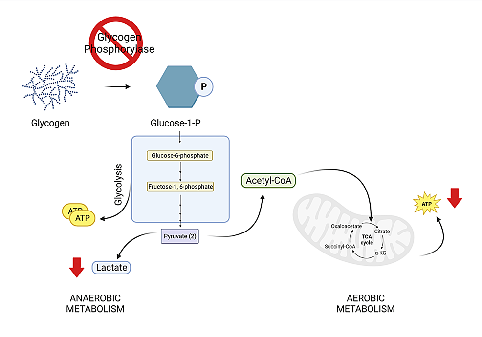 Cureus Anesthetic Management of a Patient With McArdle Disease A