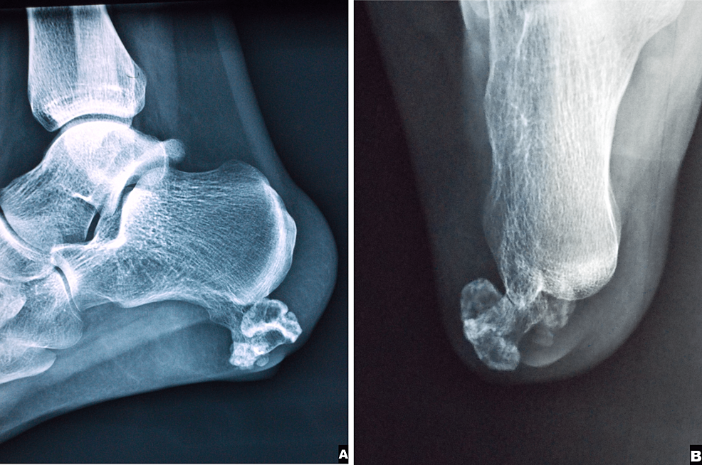 Sever's Disease and Heel Pain