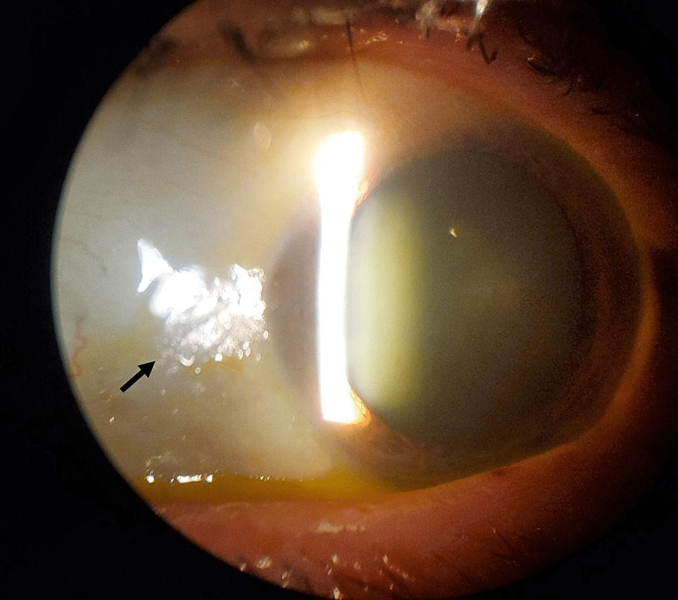 Nyctalopia and Xerophthalmia in a Patient With Crohn’s Induced Vitamin