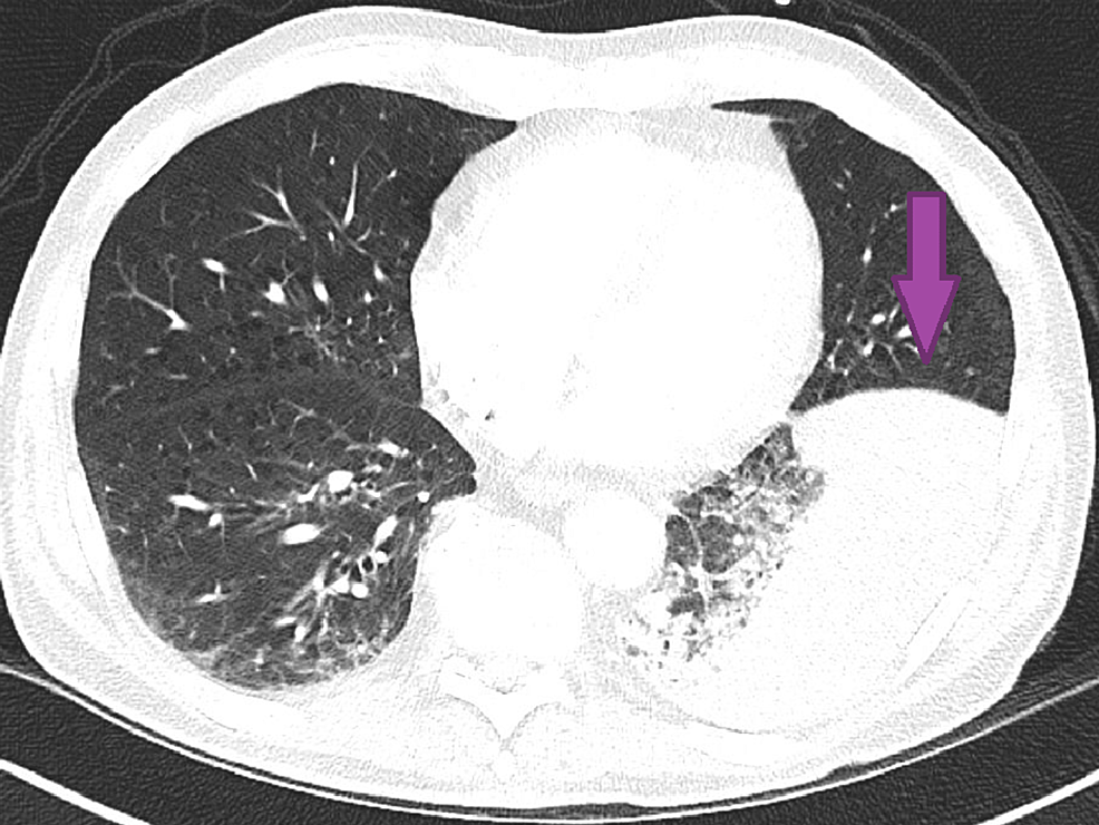 cryptococcal-pneumonia-in-a-patient-on-tyrosine-kinase-inhibitor