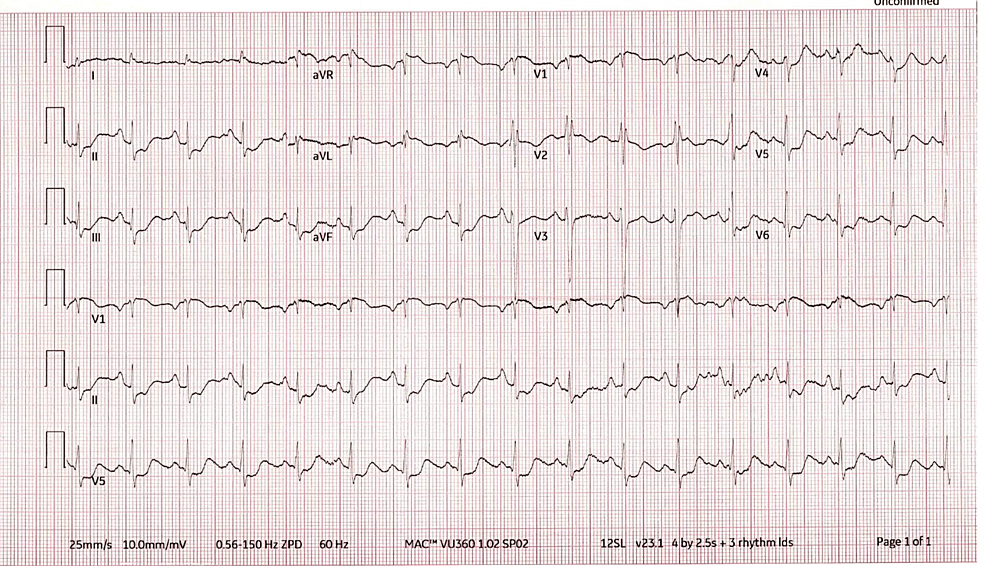 Cardiac Arrest as the Initial Presentation of Undiagnosed Kawasaki
