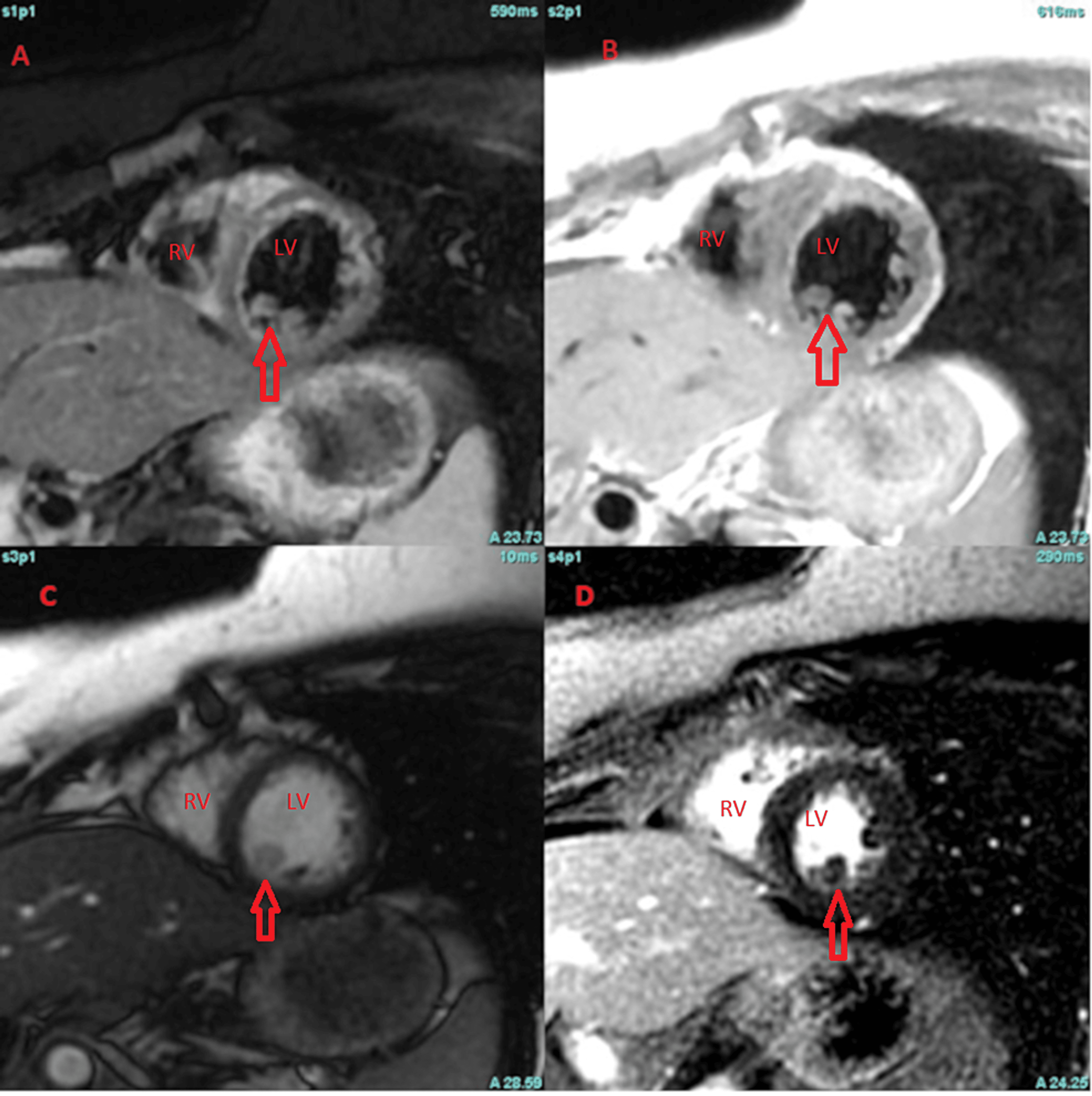 Cureus | A Case of Left Ventricular Masson’s Tumor: Not Every Heart ...