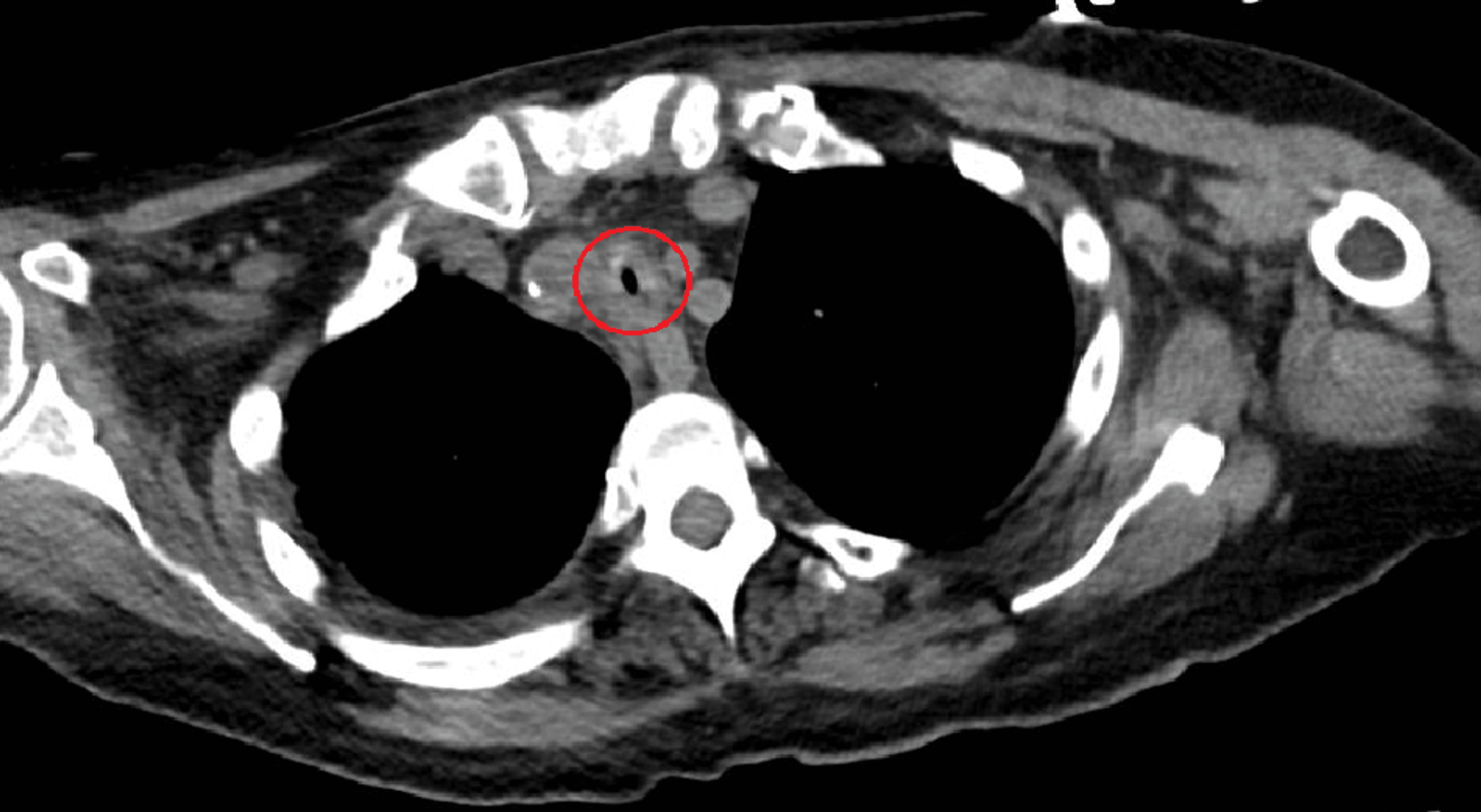 A Different Approach to the Treatment of Tracheal Stenosis Cureus