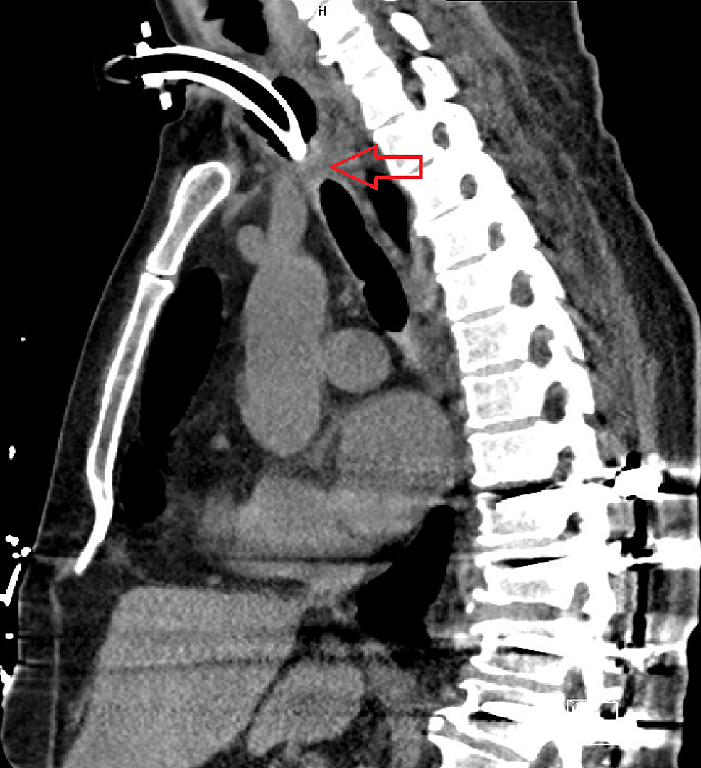A Different Approach to the Treatment of Tracheal Stenosis Cureus