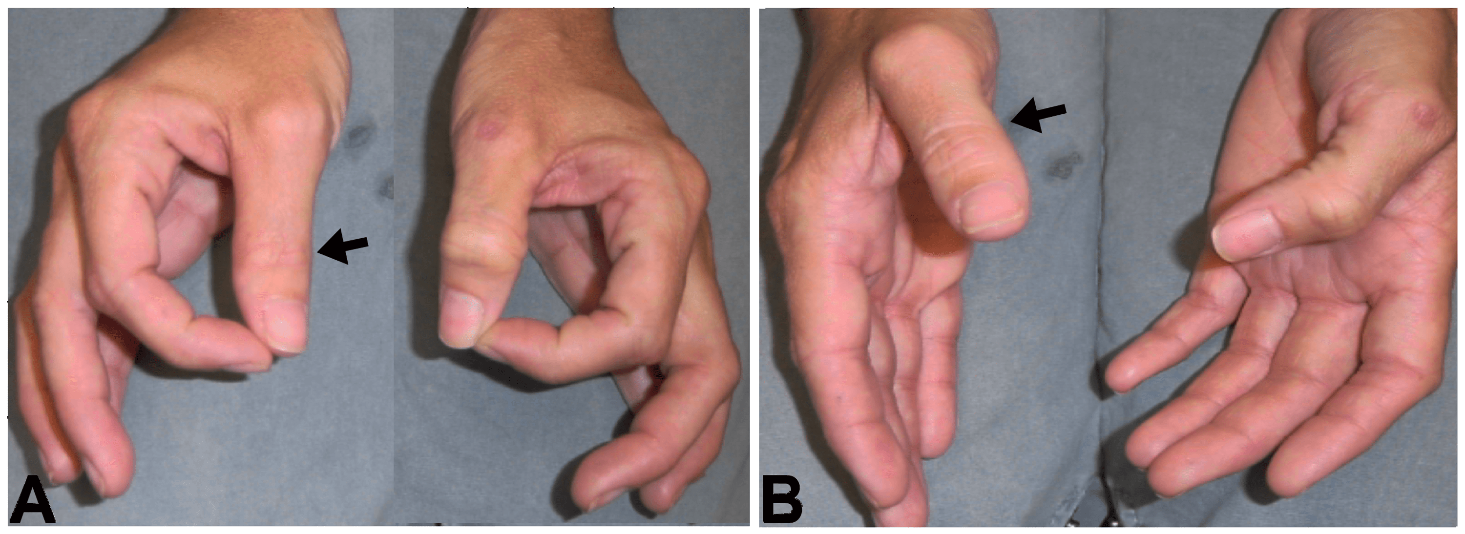 Cureus Clinical Spectrum of Postsurgical ParsonageTurner Syndrome A